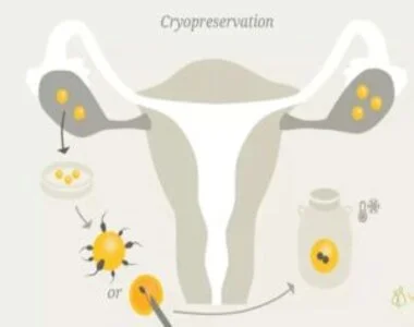 cryopreservation